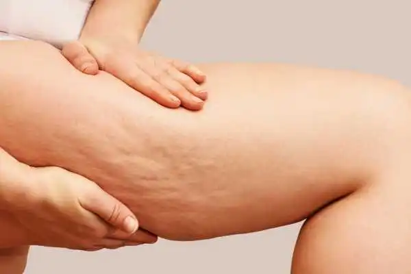 Image of woman showing leg with cellulite Chippenham