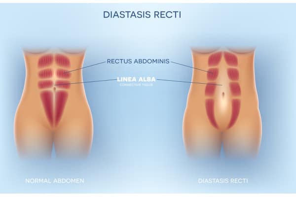 What Non-Surgical Options Are Available for Diastasis Recti Chippenham?