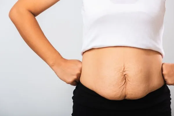 Image of a woman's stomach after weight loss with sagging skin following a gastric band Chippenham