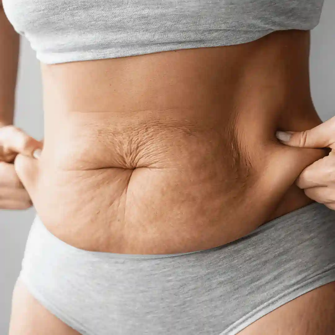 Is It Normal to Have Loose Skin After Pregnancy Chippenham?