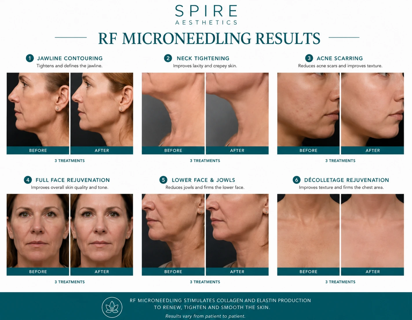 RF Microneedling Skin tightening Chippenham results