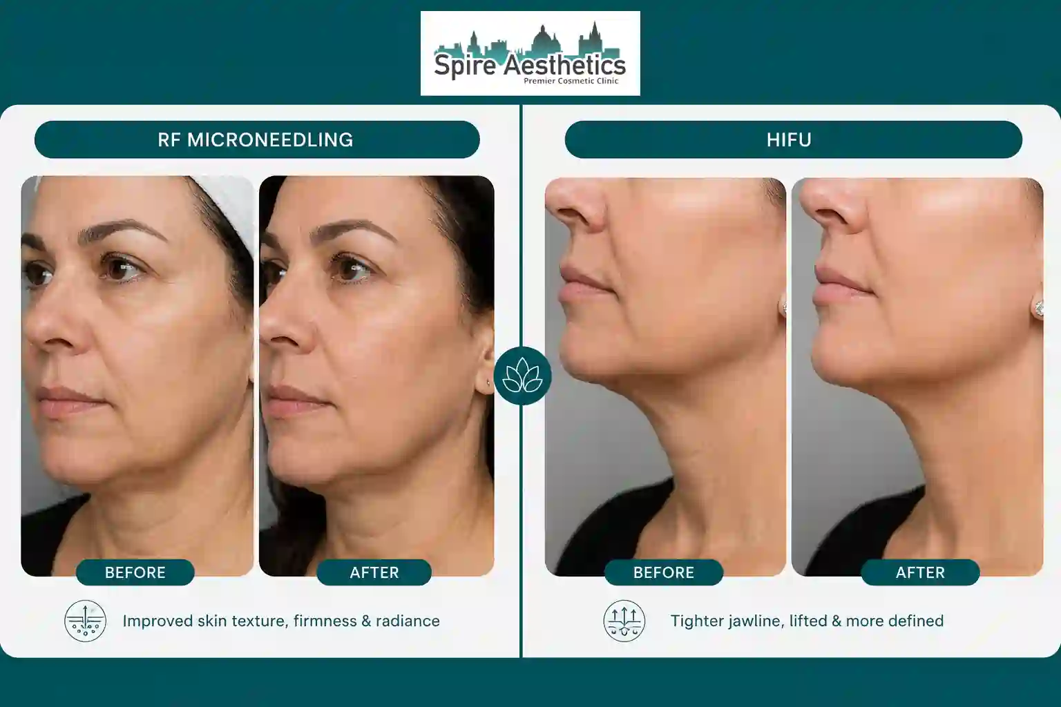 Can RF Microneedling and HIFU Be Combined Chippenham?