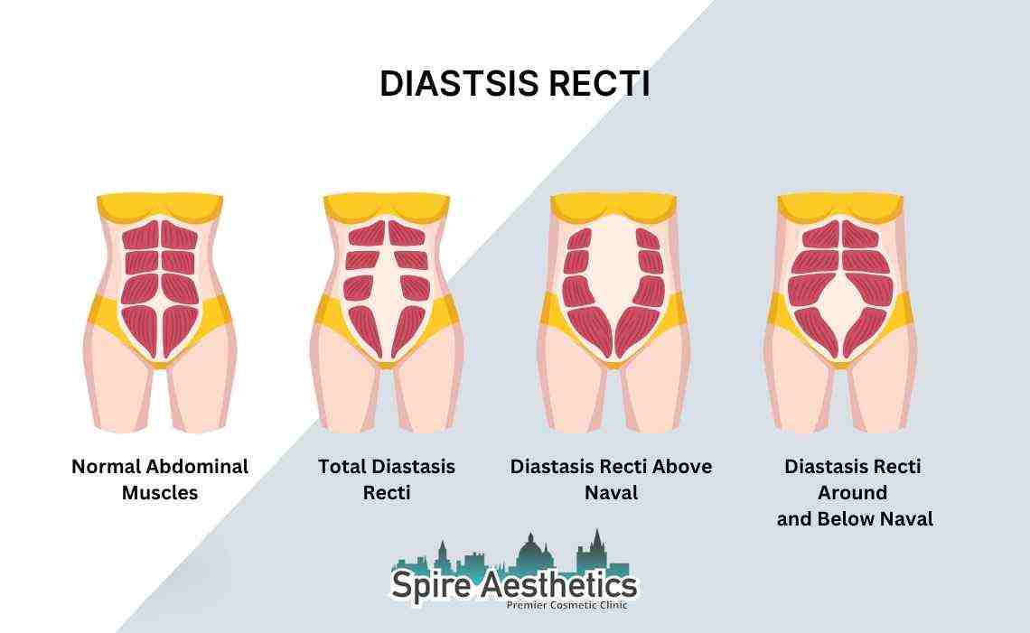 Is Non-Surgical Diastasis Recti Treatment Right for You? Common Concerns Answered Chippenham